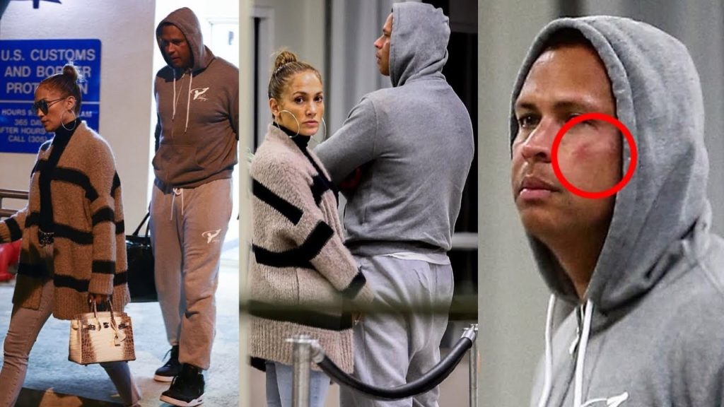 Jennifer Lopez’s new fiancé Alex Rodriguez appears to have a bruised face as couple arrive in Miami